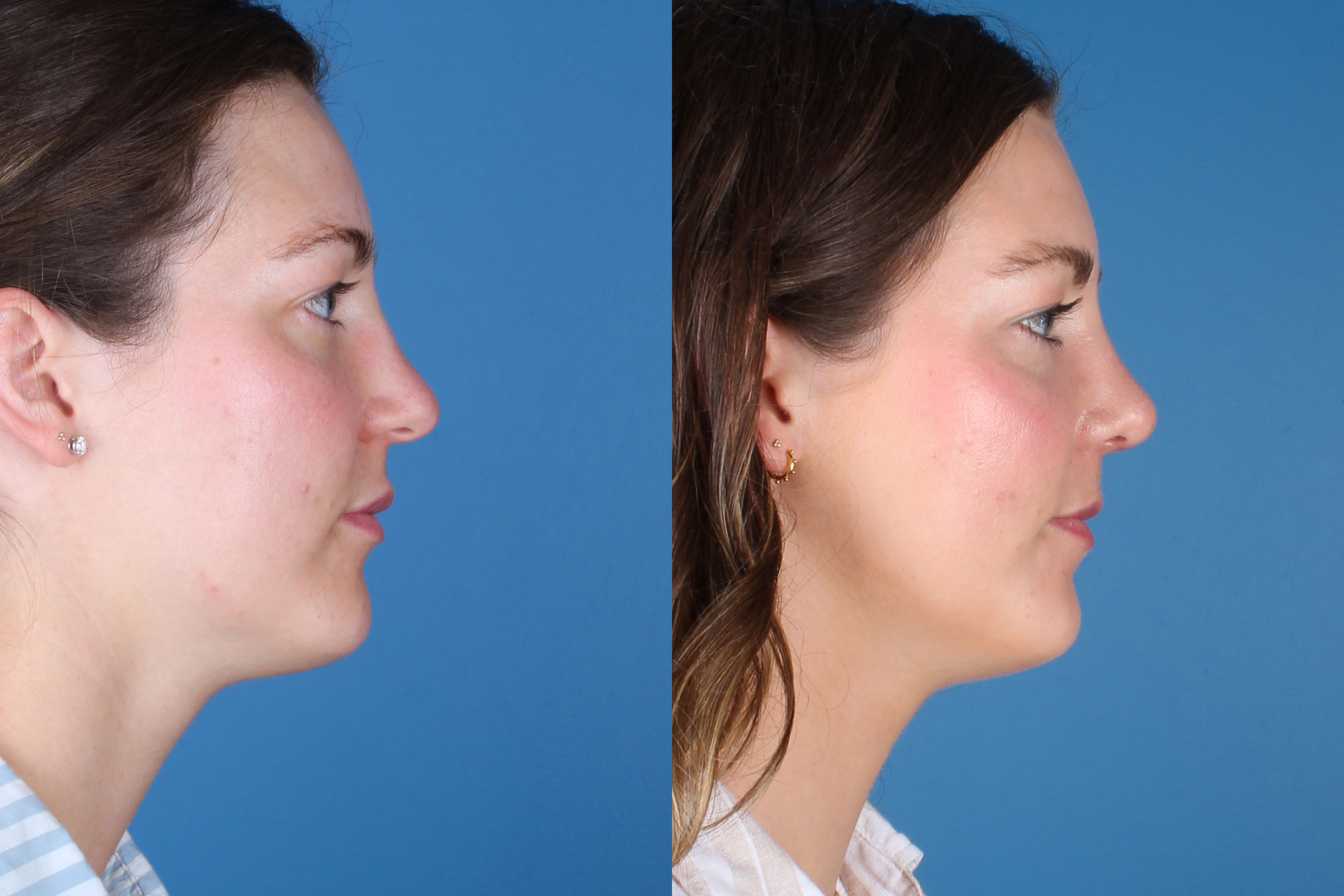 Denver Rhinoplasty Before And Afters Raval Facial Aesthetics